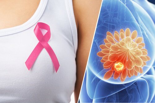 Possibile cancro al seno: individuarlo grazie a 10 indizi