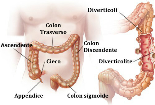 Diverticolite e diverticolosi: cosa sono e come curarle
