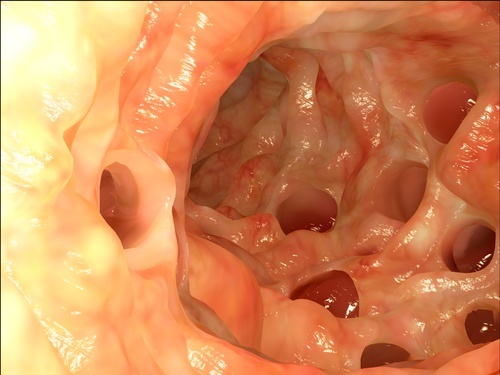 Informazioni sulla diverticolite