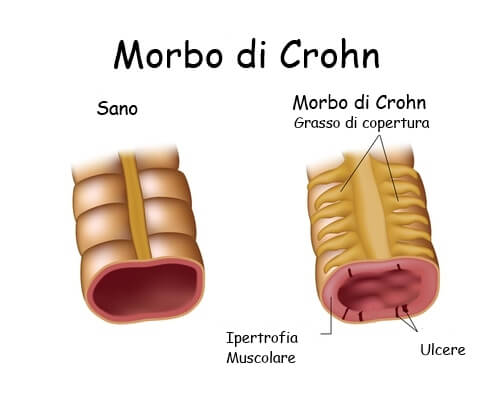 Morbo di Crohn: quale dieta seguire? Morbo di Crohn: quale dieta seguire?