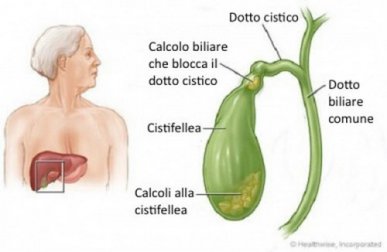 Sciogliere i calcoli biliari in modo naturale