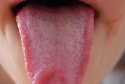 Collutori naturali per disinfettare la lingua Collutori naturali per disinfettare la lingua