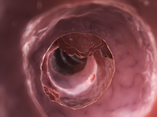 diverticolosi o diverticolite