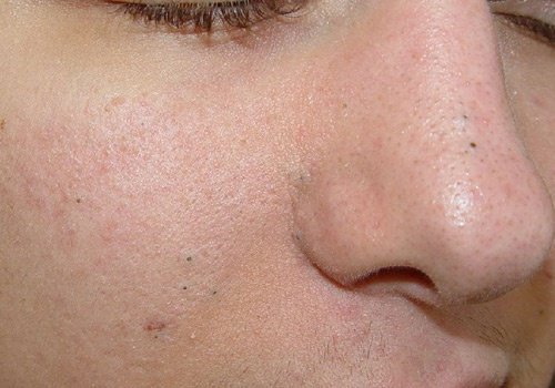 Rimedi naturali contro punti neri, verruche e macchie