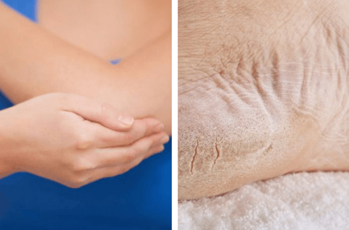 Ammorbidire gomiti e talloni con prodotti naturali