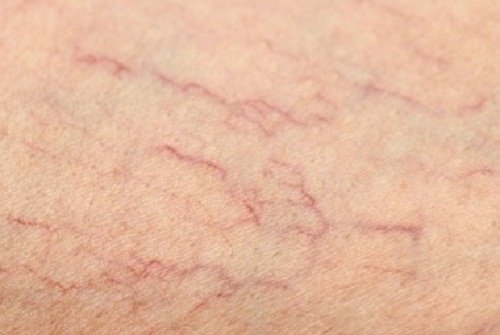Come eliminare le vene varicose dalle gambe