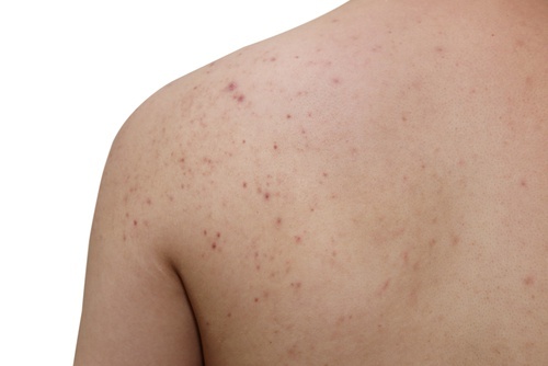 Consigli per prevenire i brufoli