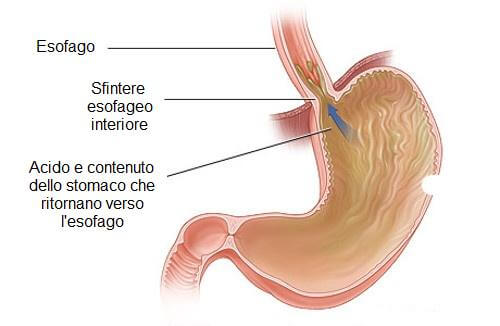 Rimedi naturali per ridurre il reflusso gastrico
