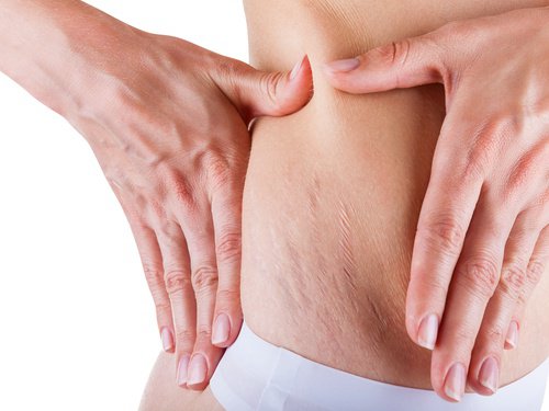 Smagliature e cellulite