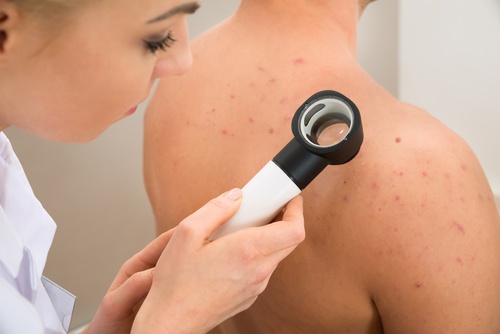 Acne sulla schiena, spalle e petto: tutte le cure naturali