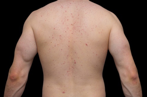 Acne sulla schiena