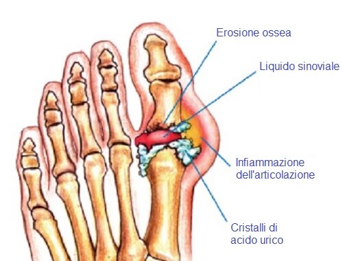 Cristalli di acido urico nelle articolazioni: come eliminarli?