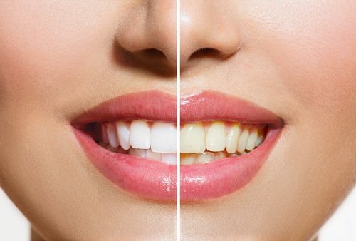Usi cosmetici del sale per denti bianchi