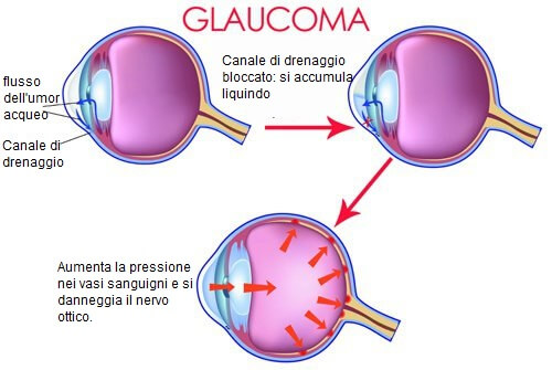 il glaucoma