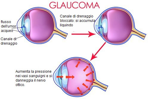 Il glaucoma: quando si verifica e come evitarlo