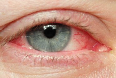 l'occhio e il glaucoma
