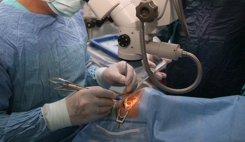 Operazione agli occhi per foro maculare.