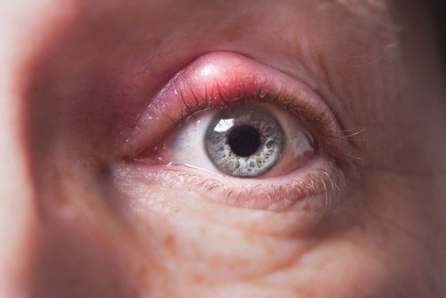 Combattere l'orzaiolo con trattamenti naturali