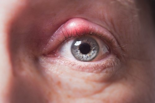 Combattere l'orzaiolo con trattamenti naturali