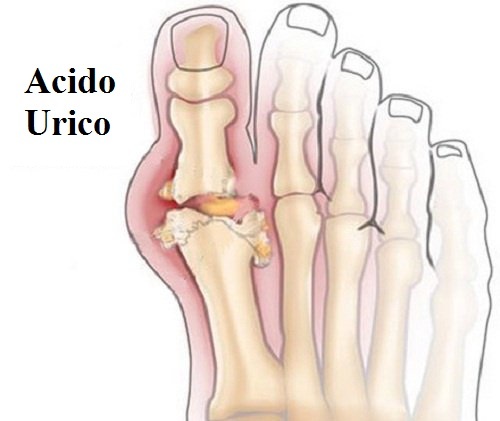 piedi con acido urico