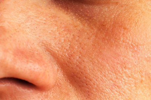 Ridurre i pori dilatati della pelle con 5 soluzioni naturali
