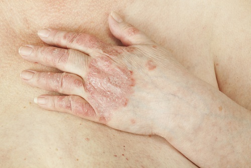 psoriasi alle mani