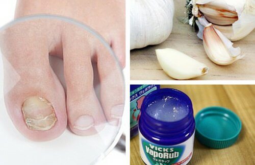 Infezioni da funghi: 7 rimedi per combatterle