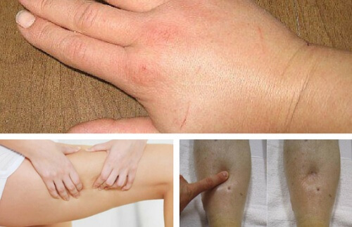 Combattere la ritenzione idrica con i diuretici naturali