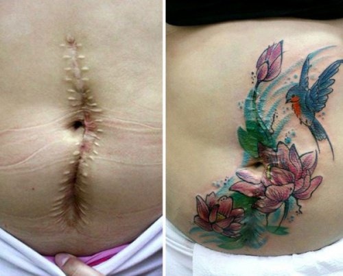 Tatuaggi medici: così si può coprire le cicatrici (e ridisegnare