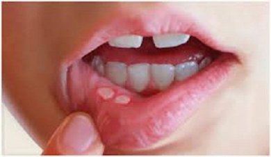 Come trattare le afte con rimedi naturali