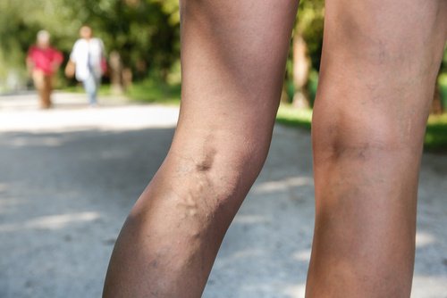 Varicosity e il suo trattamento e prevenzione