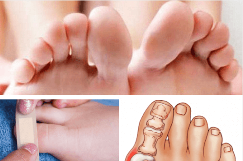 Come curare lesioni e malattie delle dita dei piedi