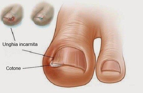Unghia incarnita