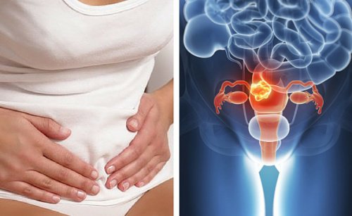 7 sintomi del cancro alla cervice uterina