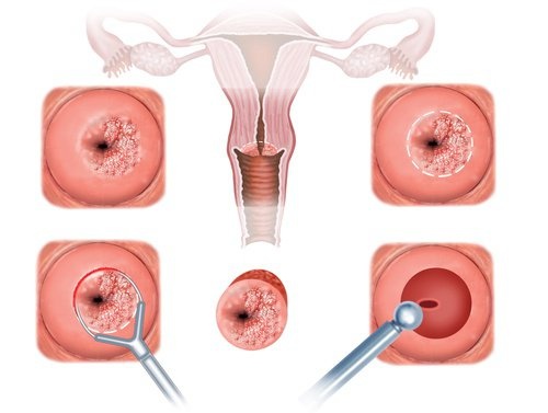 Cervice uterina