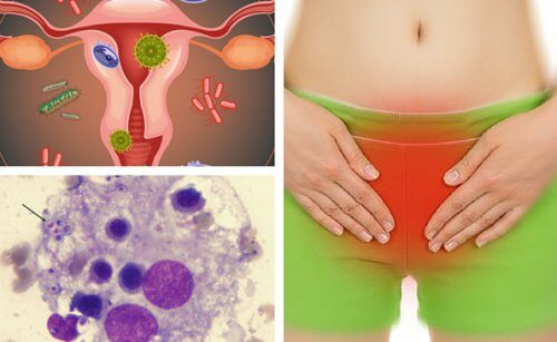 Le micosi vaginali: combatterle con alcuni consigli