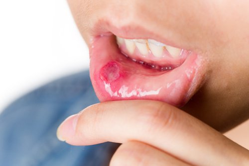 6 rimedi naturali per le afte in bocca