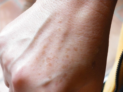 Macchie sulle mani: creme naturali per eliminarle