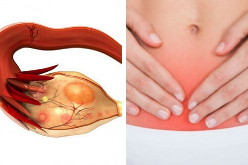 Tumore dell'ovaio: 7 segnali che rivelano il killer silenzioso