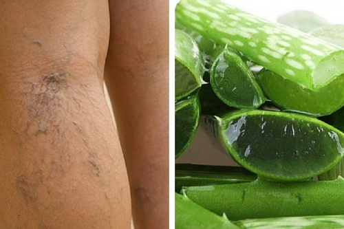 Aloe vera per trattare le ulcere varicose