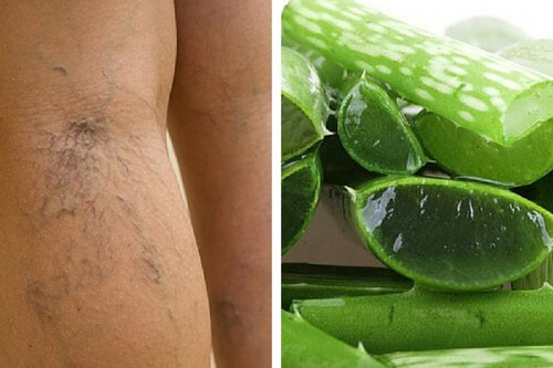 Ulcere varicose: integratore a base di aloe vera per trattarle