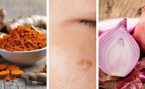 Macule cutanee: 6 rimedi naturali per eliminarle