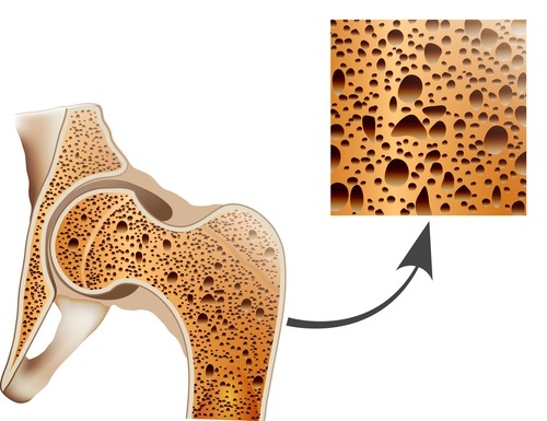 graviola e osteoporosi