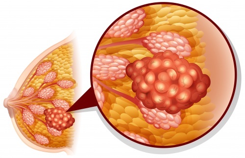 imprecisione screening mammografico