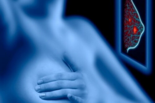 Screening Mammografico: i rischi superano i vantaggi?