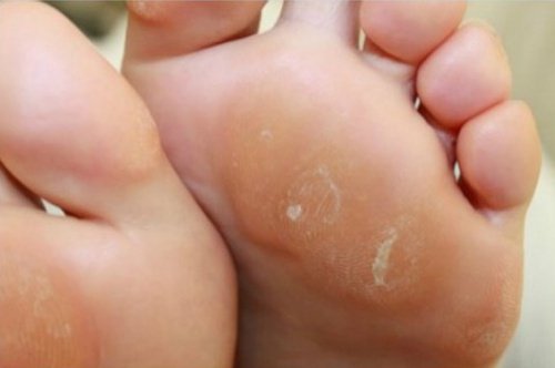 3 creme naturali per eliminare i calli dei piedi