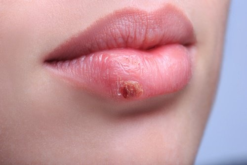 Herpes labiale, come trattarlo in modo naturale
