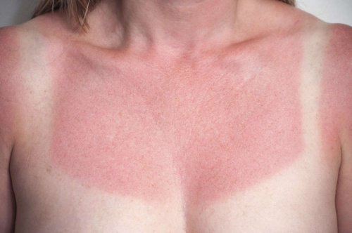 Scottature solari: 5 rimedi naturali