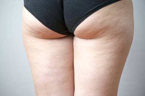 Combattere la cellulite