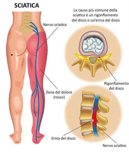 Sciatica